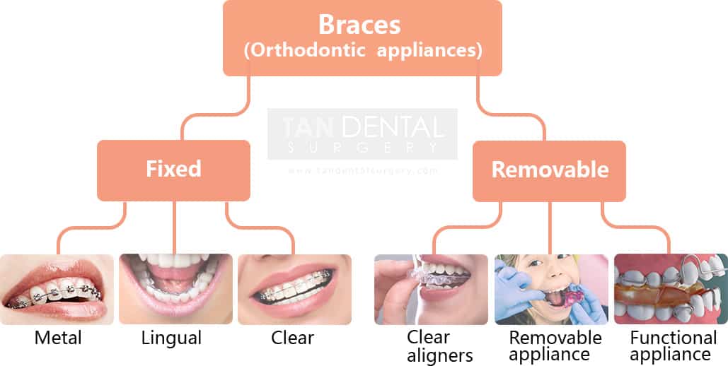 Comparison between metal braces, clear braces and clear aligners