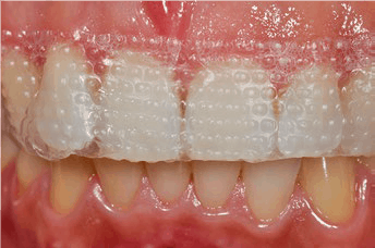 Comparison between metal braces, clear braces and clear aligners