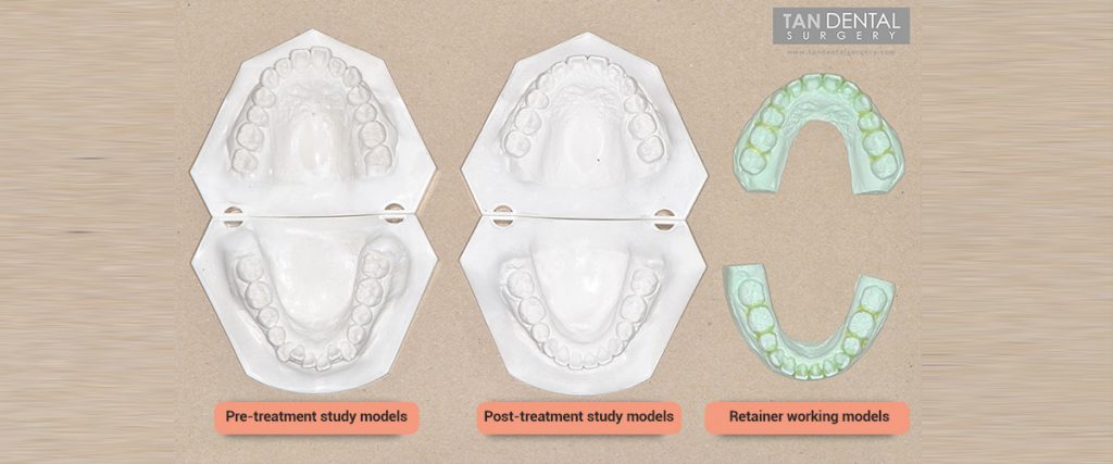 Comparison between metal braces, clear braces and clear aligners