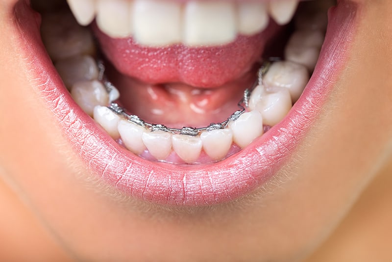 X on X: Metal Braces VS Clear Aligners #orthodontics #dental