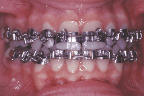 Fully banded braces new arrivals