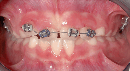 Partial braces on sale