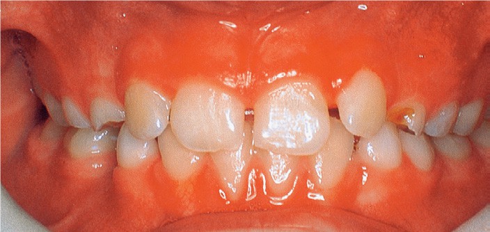 Orthodontics Braces Tan Dental Surgery