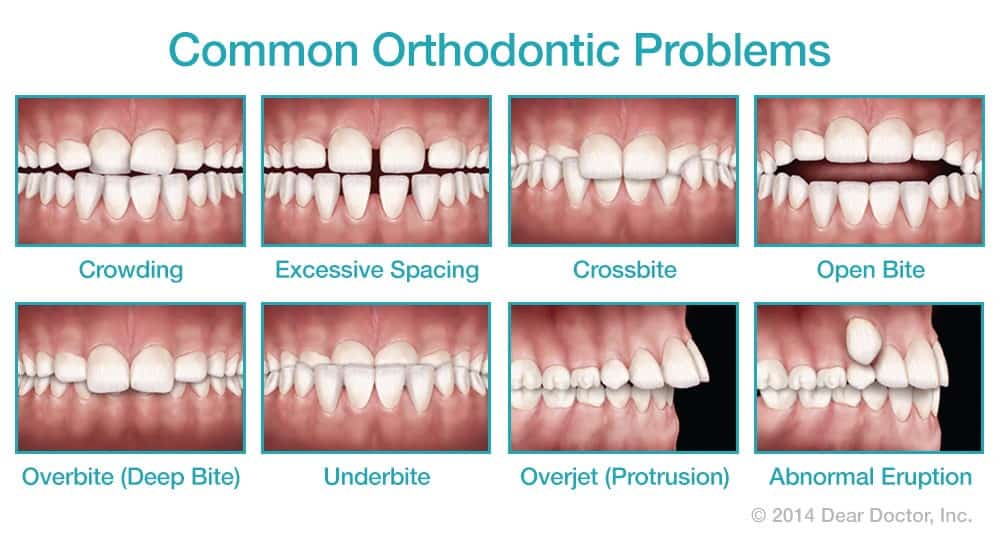 Can I Get Braces on Just My Bottom Teeth - Orthodontics Liited