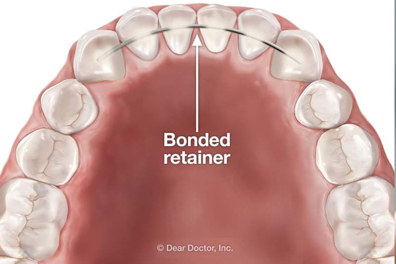 Comparison between metal braces, clear braces and clear aligners