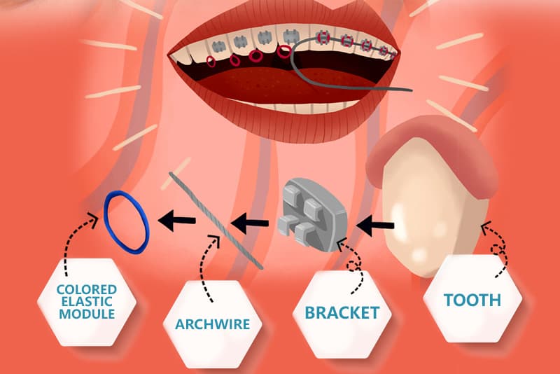 X on X: Metal Braces VS Clear Aligners #orthodontics #dental